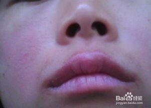 吃瓜嘴唇过敏,揭秘过敏背后的真相
